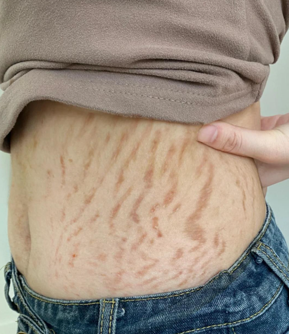 妊娠纹1